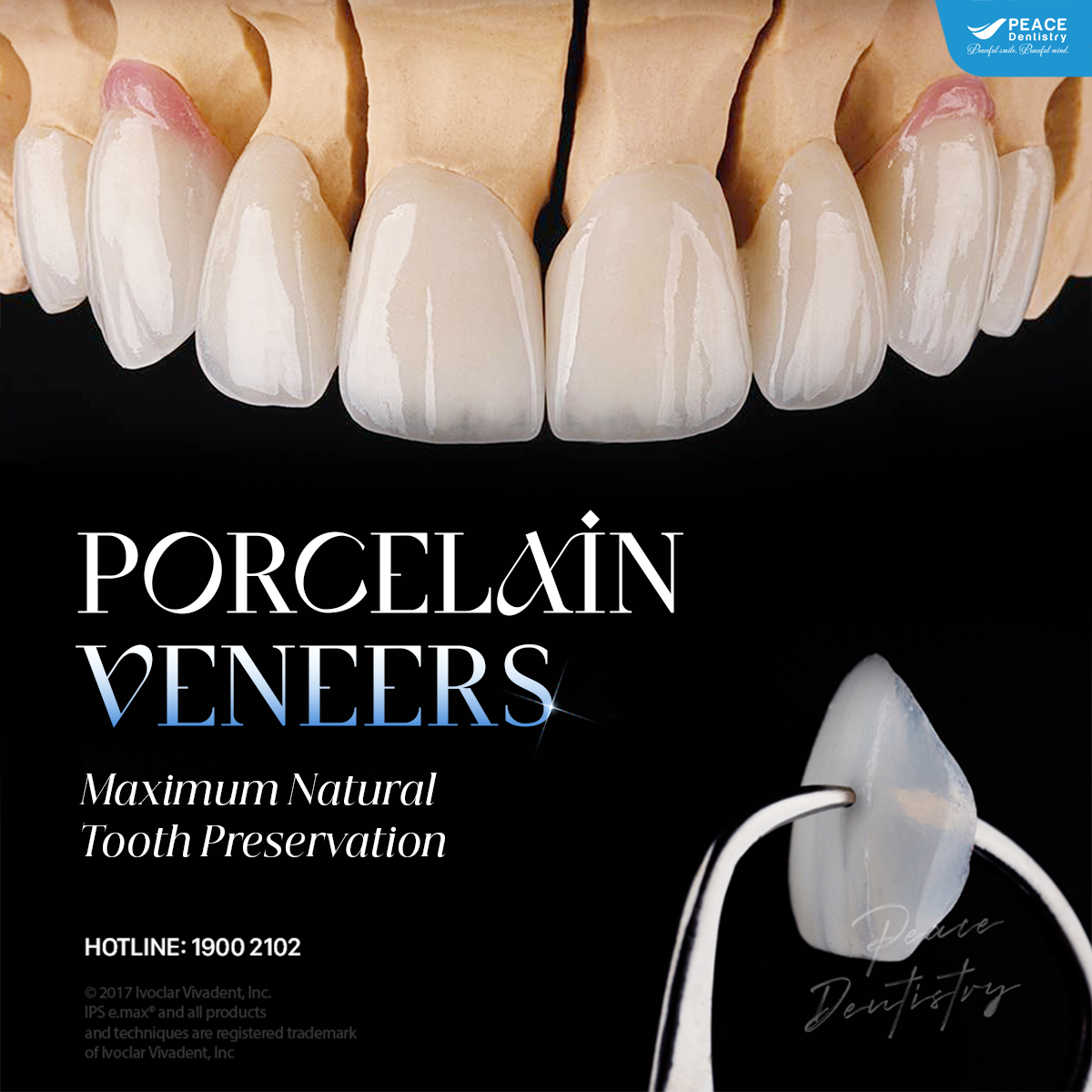 banner dán sứ veneer