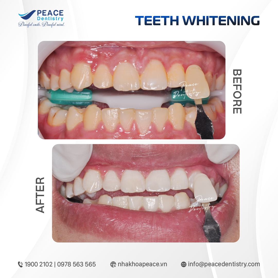 before after teeth whitening 1