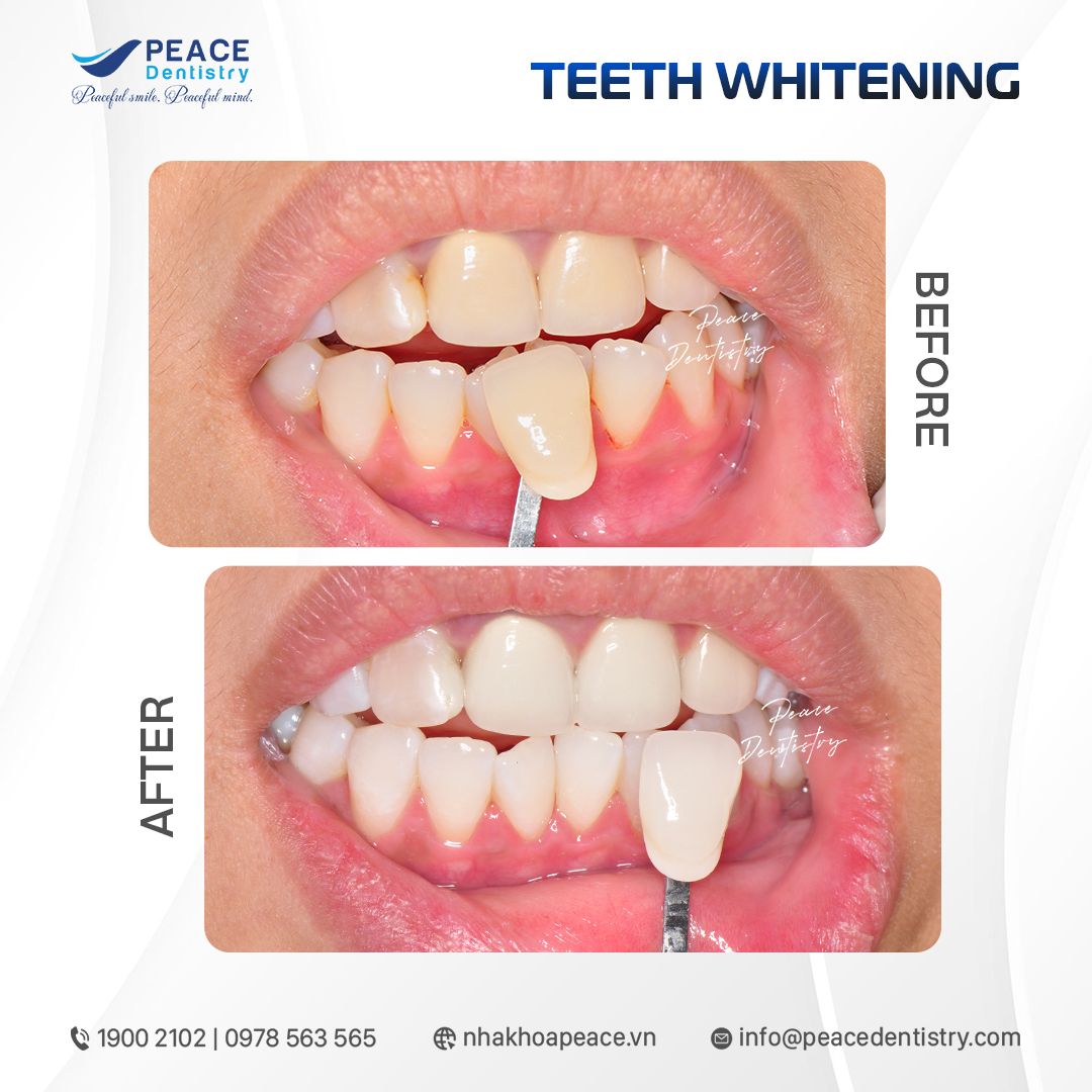 before after teeth whitening 2