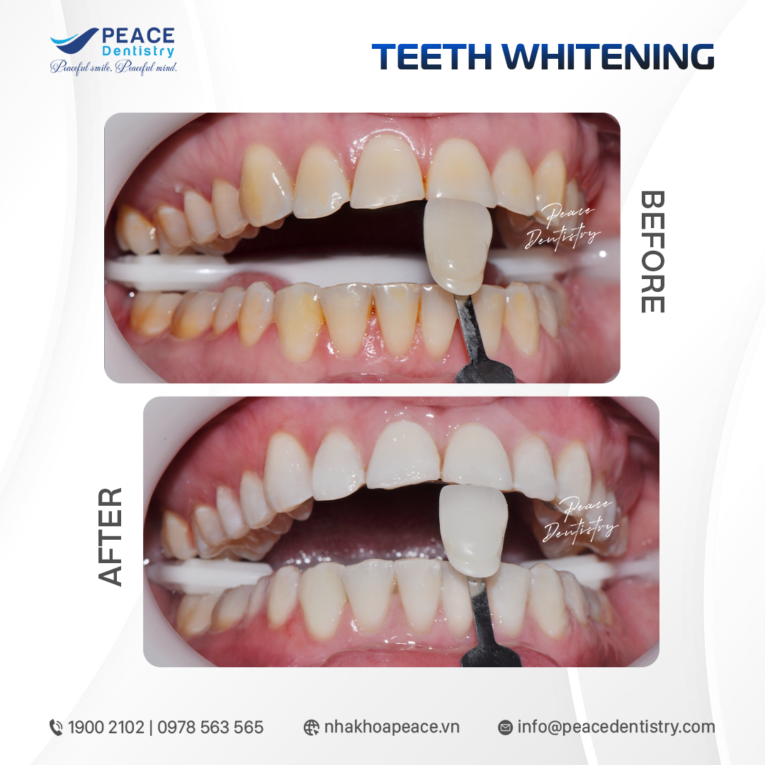 before after teeth whitening 3
