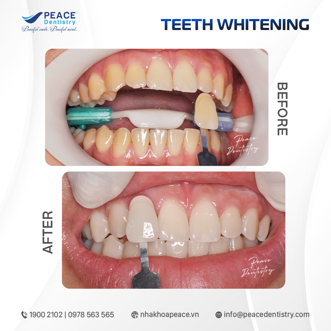 before after teeth whitening 4