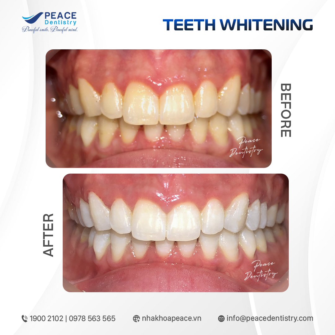 before after teeth whitening 5