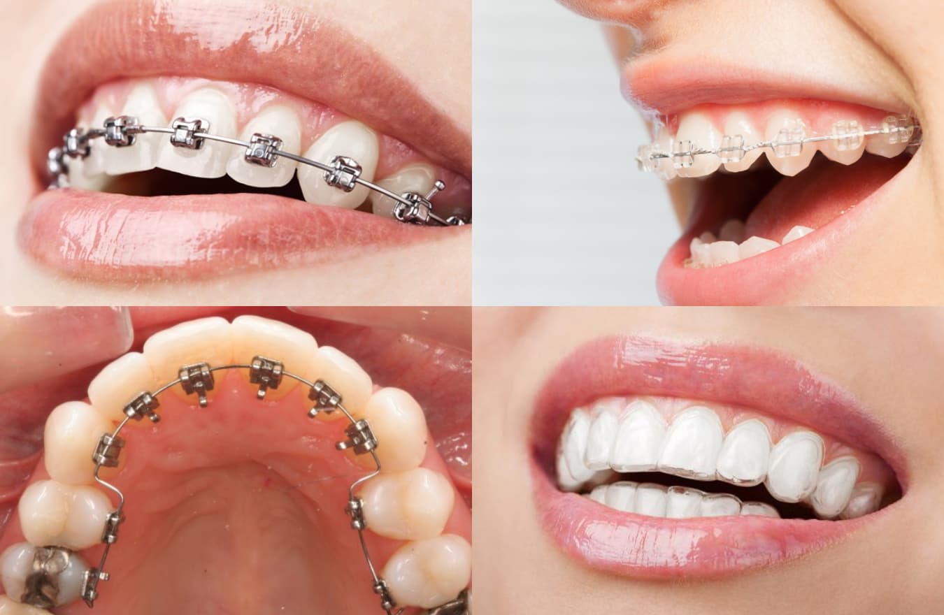 các loại niềng răng mắc cài