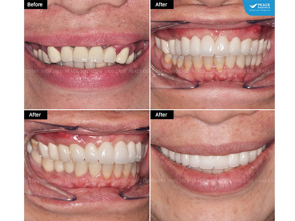 cấy ghép Implant cho khách hàng lớn tuổi, mất răng nhiều năm và đang sử dụng cầu răng sứ dài đã xuống cấp