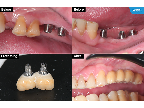 cấy ghép Implant cho khách hàng Việt kiều trong tình trạng mất nhiều răng hàm