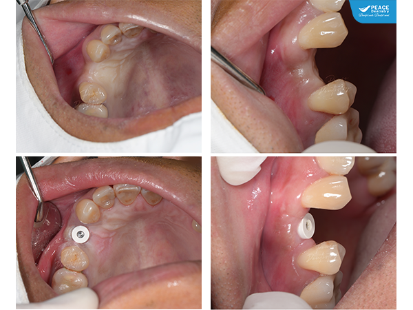 Cấy ghép Implant R14 có ghép xương cho khách hàng trong tình trạng mất răng nhiều năm