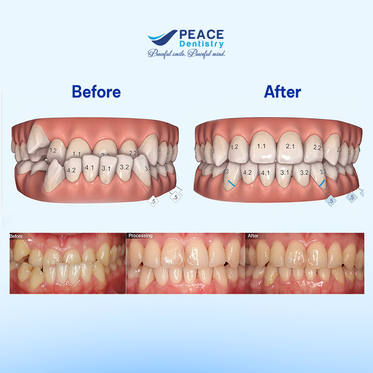 niềng răng invisalign biết trước kết quả