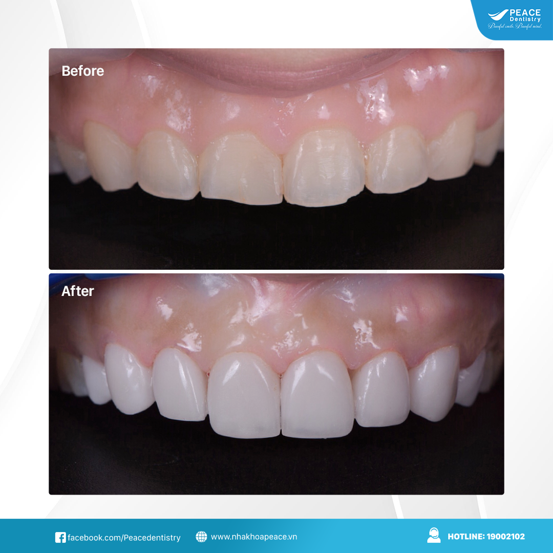 dán sứ veneer cho răng gãy mẻ