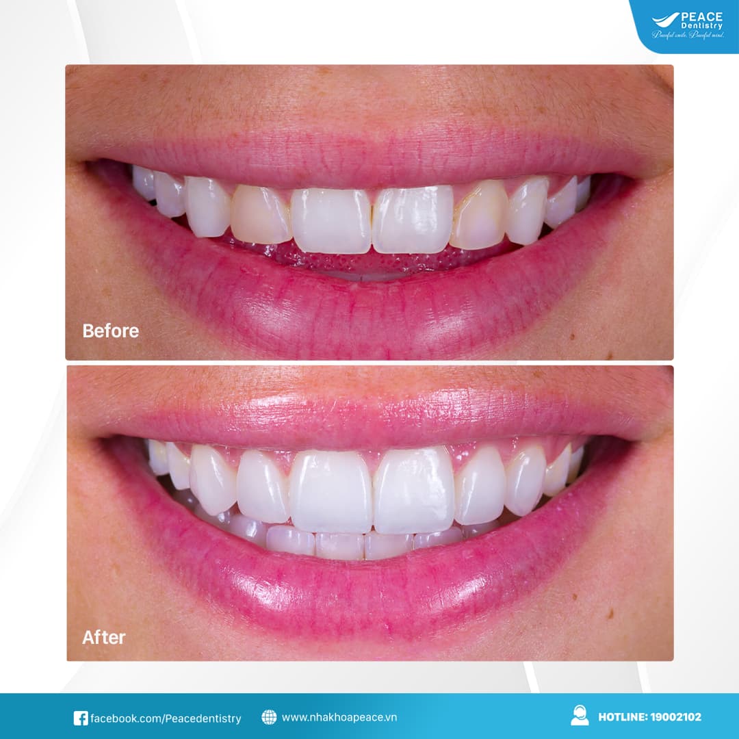 dán sứ veneer cho răng không đồng màu