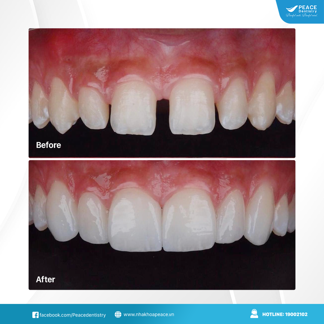 dán sứ veneer cho răng thưa