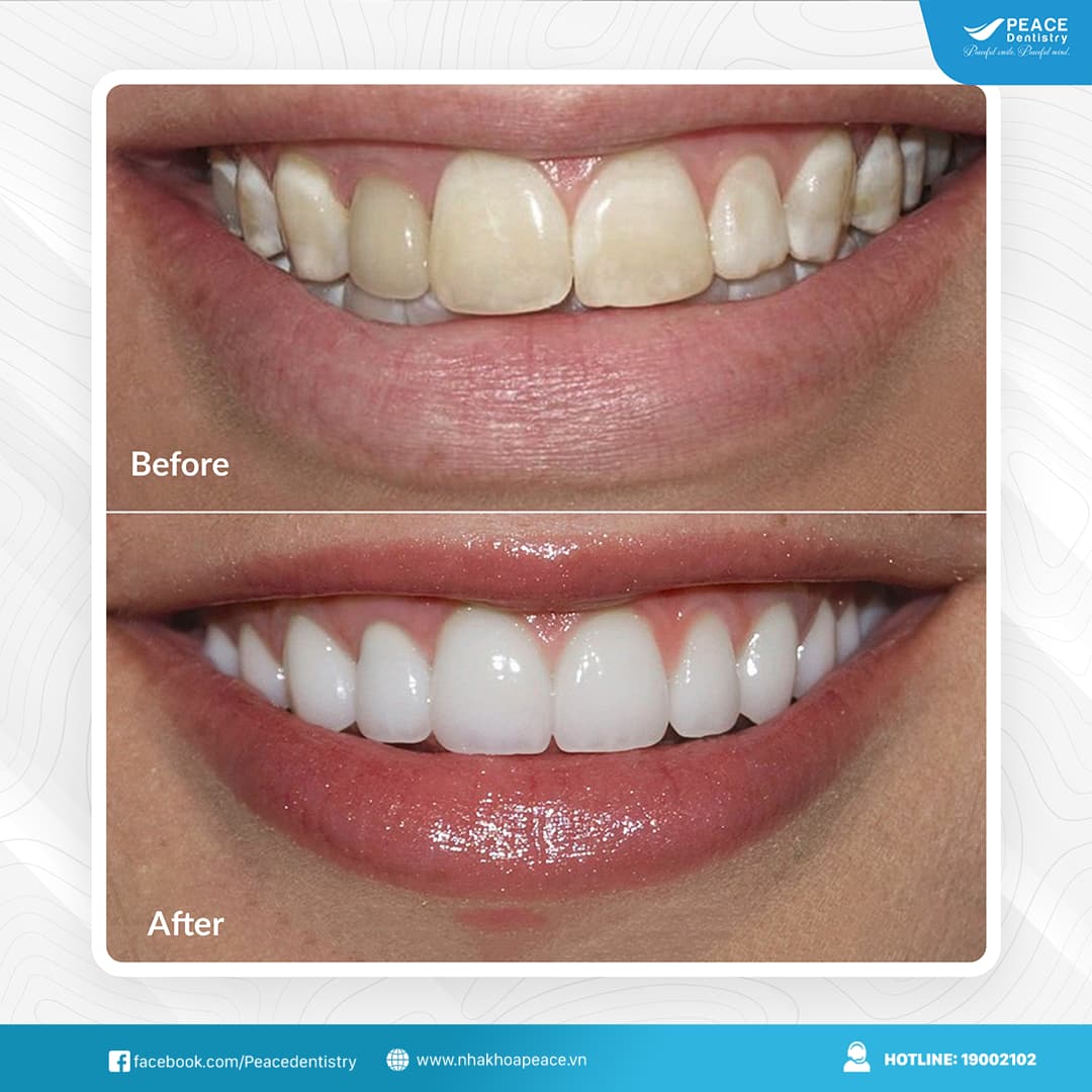 dán sứ veneer cho răng tối màu