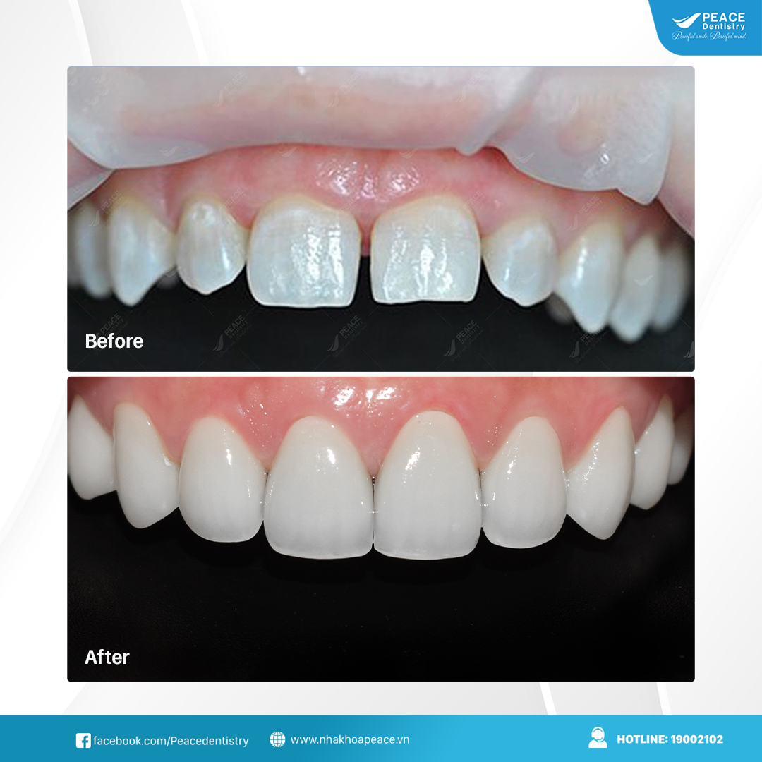 thẩm mỹ nụ cười với dán sứ veneer