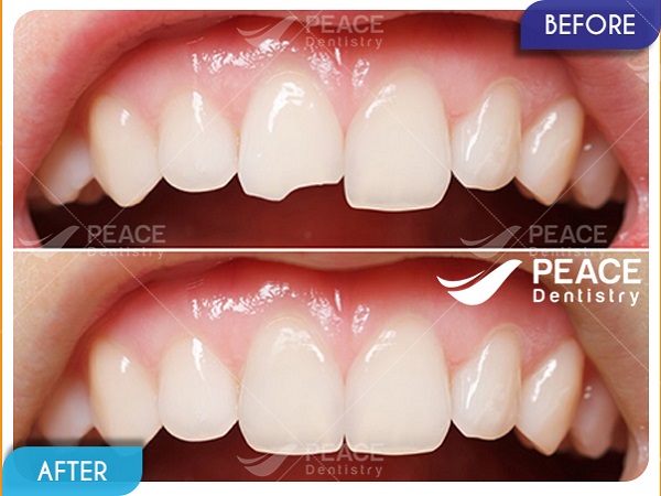 Dán 1 mặt sứ khắc phục răng cửa bị mẻ