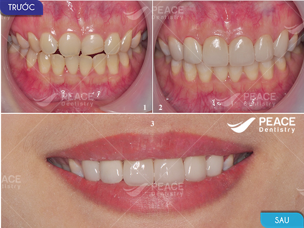 Dán 4 mặt sứ cho răng hình thể xấu, hở kẽ