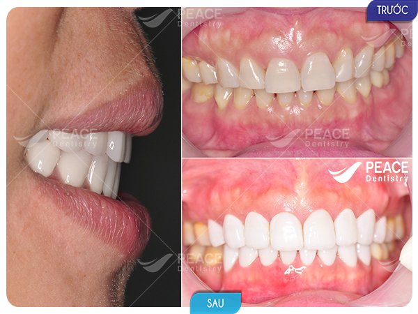 Dán mặt sứ Veneer thẩm mỹ nụ cười