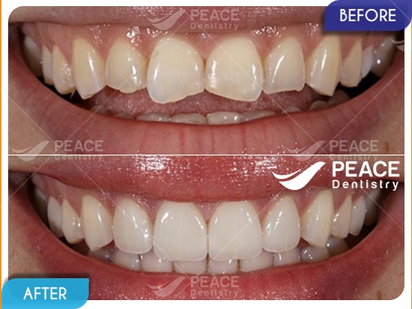 Dán 4 mặt sứ Veneer cho răng hình thể xấu, răng mẻ