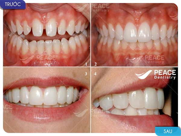 Dán 4 mặt sứ Veneer cho răng thưa