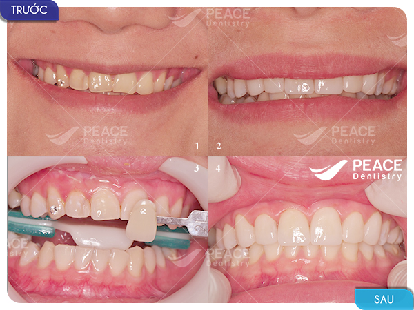 Dán 6 mặt sứ Veneer điều chỉnh hình thể răng