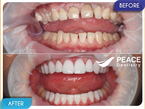 Dán mặt sứ Veneer và bọc sứ - thẩm mỹ răng toàn diện