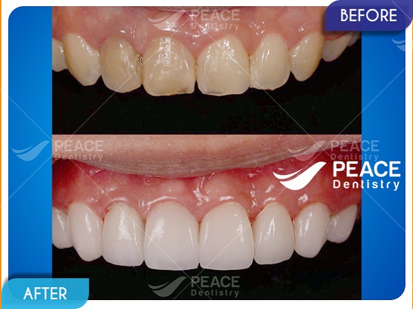 Dán mặt sứ Veneer cho răng hàm trên tối màu, hình thể xấu