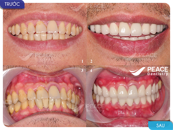 Dán mặt sứ Veneer cho răng tối màu, kết hợp điều chỉnh hình thể răng