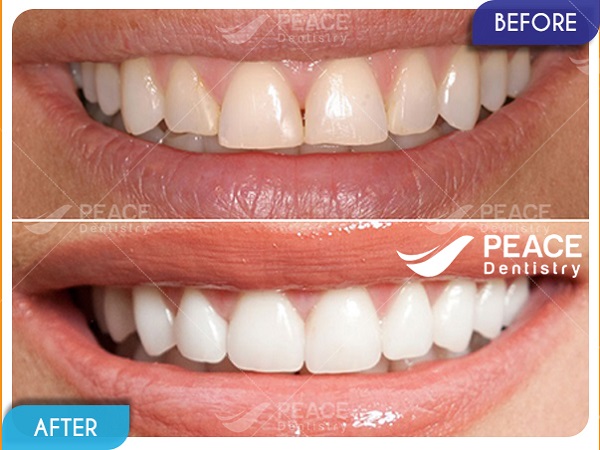 Dán mặt sứ Veneer - thẩm mỹ răng toàn diện