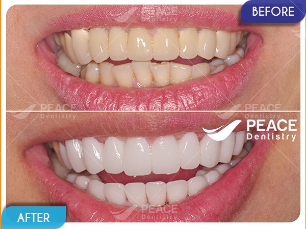 Dán mặt sứ Veneer, bọc răng sứ - thẩm mỹ răng toàn diện