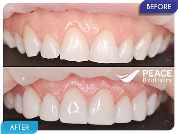 Dán 6 mặt sứ Veneer cho răng mẻ và ngắn