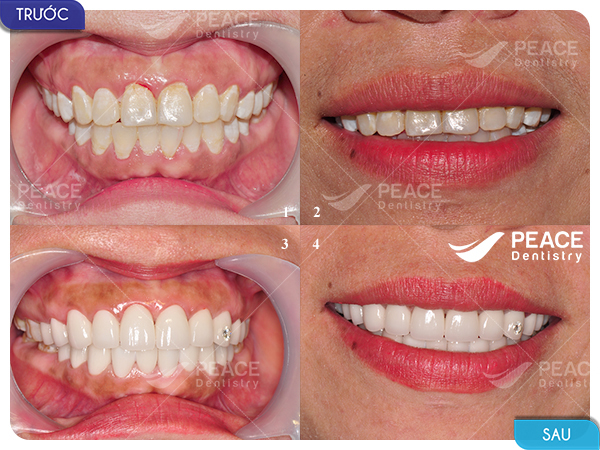 Dán mặt sứ Veneer, bọc sứ và đính đá