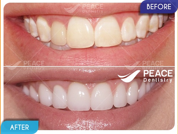 Dán mặt sứ Veneer Emax cho răng nhiễm fluor