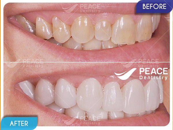 Dán mặt sứ Veneer cho răng tối màu
