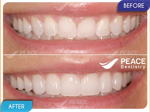 Dán 4 mặt sứ Veneer siêu mỏng điều chỉnh hình thể răng cửa