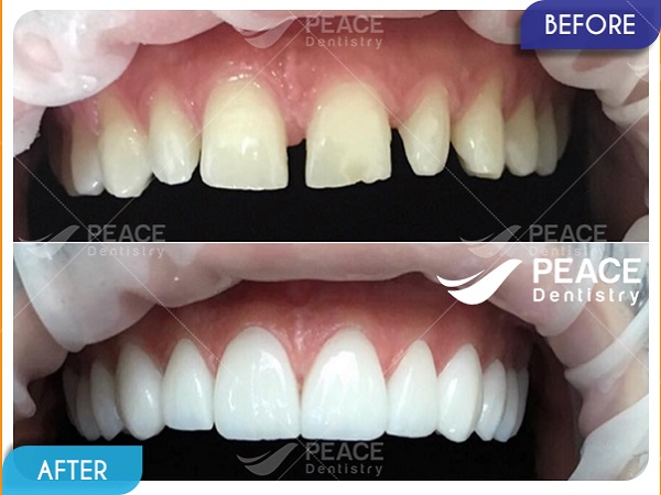 Dán mặt sứ Veneer cho răng thưa, hình thể xấu