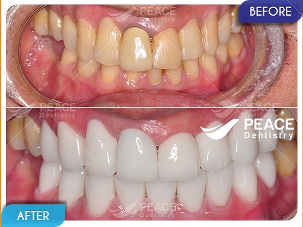 Dán mặt sứ Veneer và bọc sứ cho răng tối màu