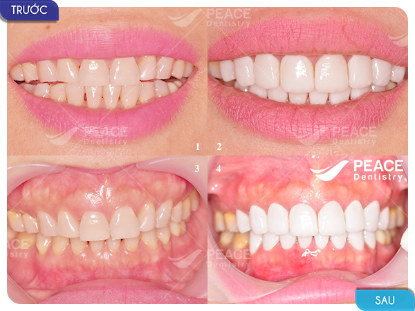 Dán 14 mặt sứ Veneer cho răng tối màu, hình thể xấu, hở kẽ răng