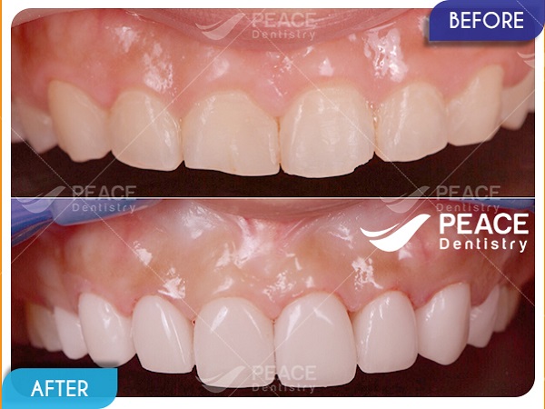 Dán mặt sứ Veneer cho răng quá ngắn