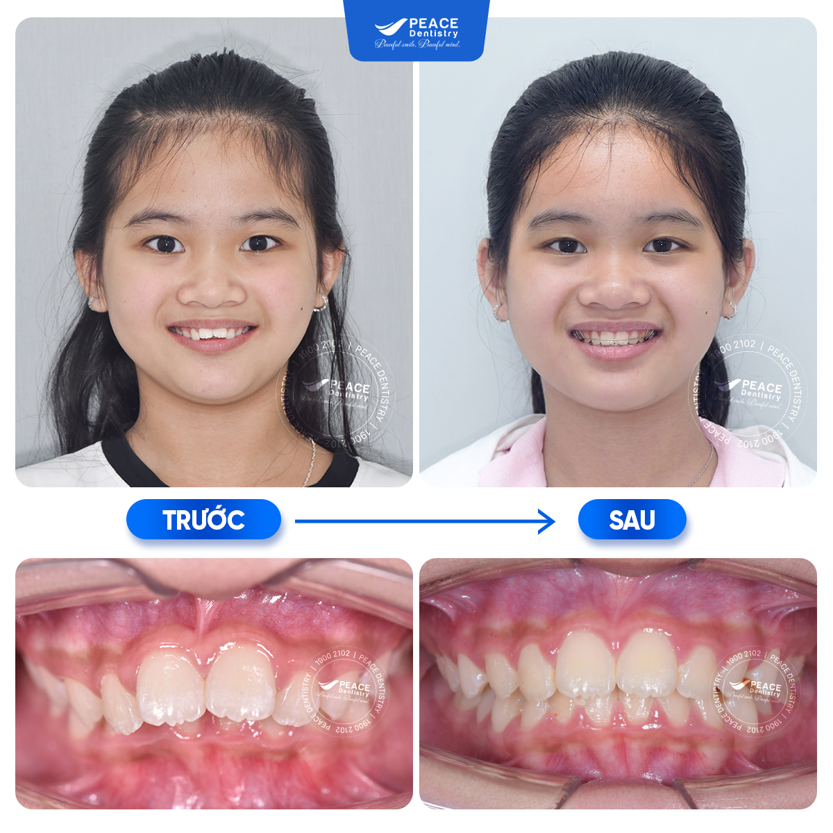 hình ảnh khách hàng tháo nguyên sau 6 tháng niềng răng
