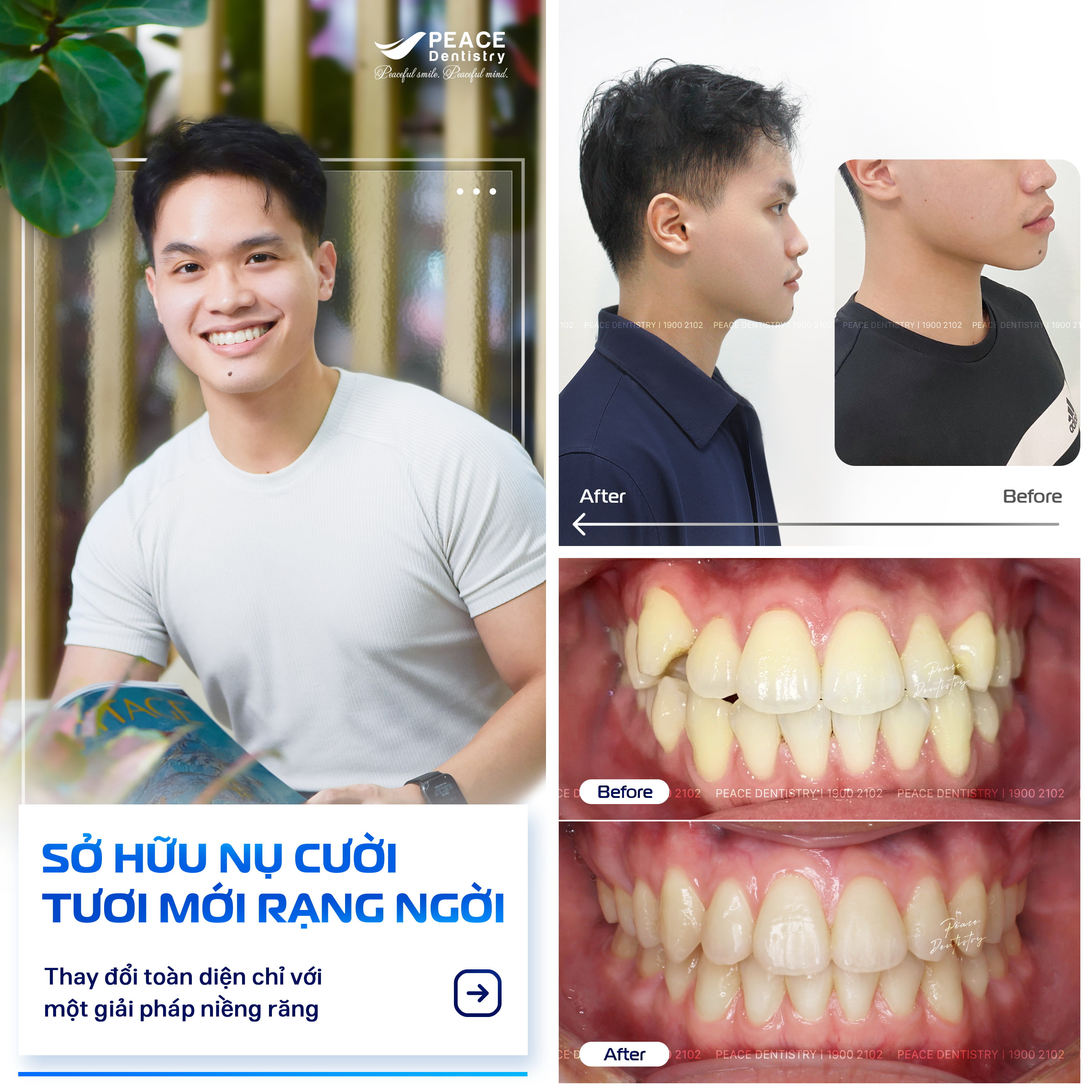 hình ảnh khách hàng trường giang sau 27 tháng niềng răng