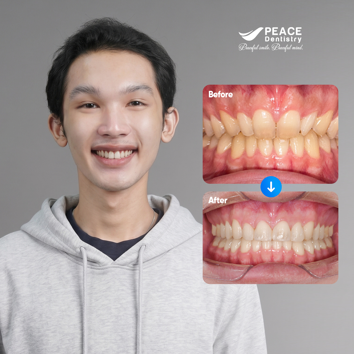 hình ảnh khách hàng tường sau 22 tháng niềng răng