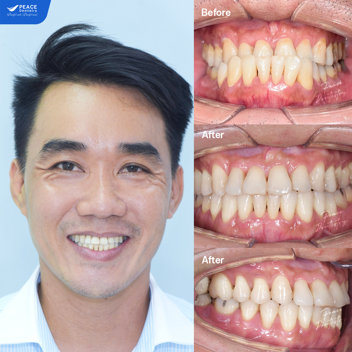 hình ảnh khách hàng xuân hiệp sau 12 tháng niềng răng
