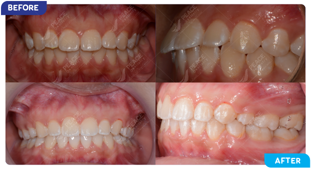 image of a patient undergoing orthodontic treatment 2