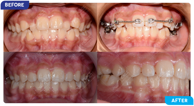 image of a patient undergoing orthodontic treatment 3