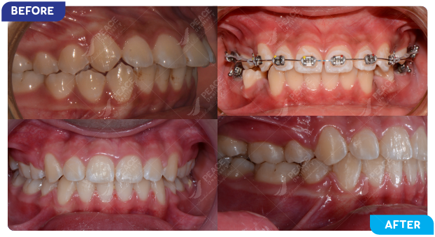 image of a patient undergoing orthodontic treatment 4