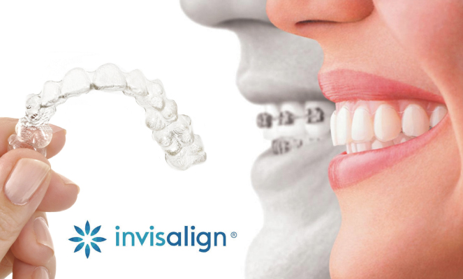 niềng răng invisalign