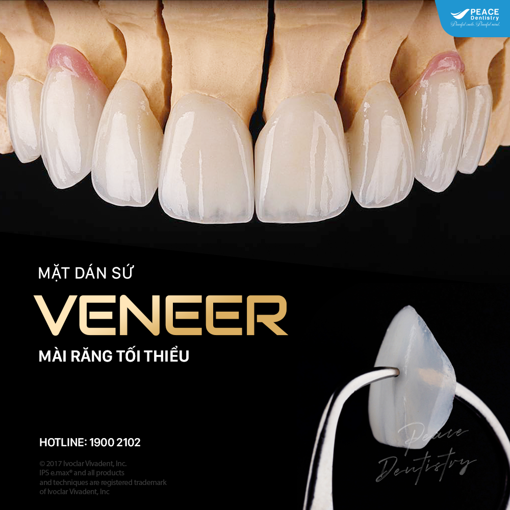 mặt dán sứ veneer cao cấp chính hãng