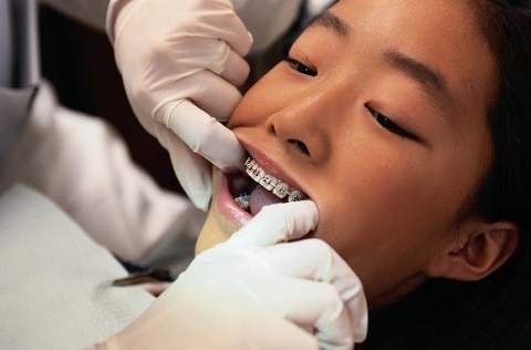 răng xô lệch ở trẻ em