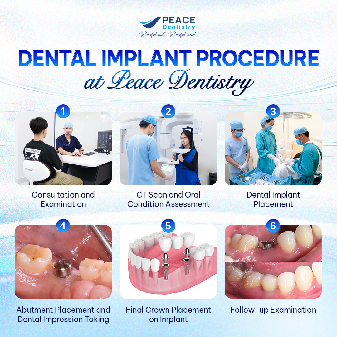 quy trình cấy ghép implant chuẩn ICOI