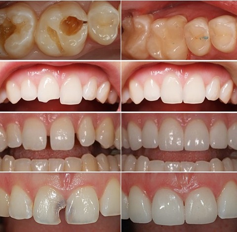 trường hợp trám răng thẩm mỹ