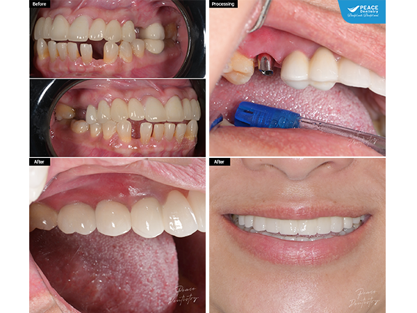 trồng răng implant cho mất răng hàm và tiêu xương vị trí R16, Cầu răng dài ở hàm trên và răng thưa ở hàm dưới