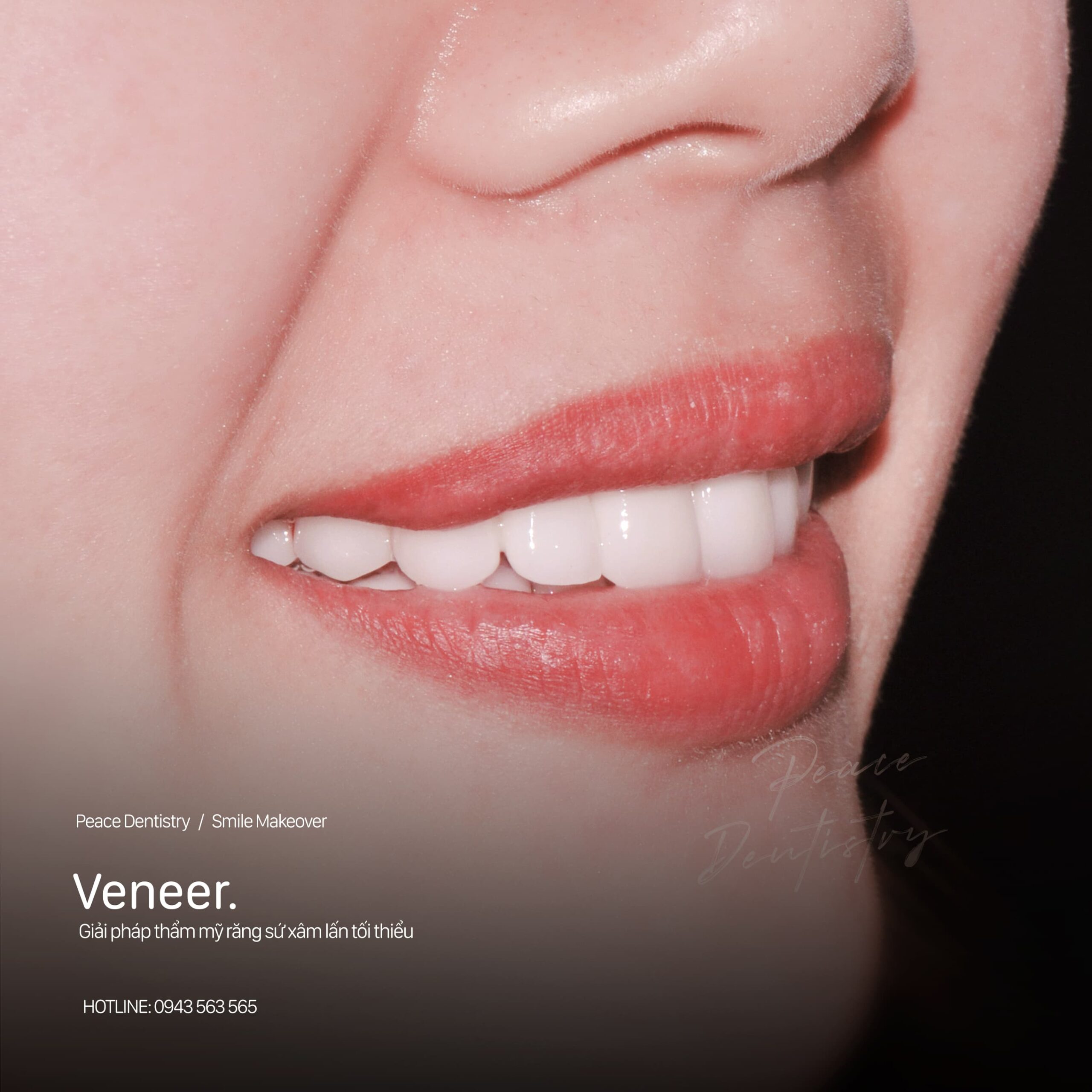 tư vấn dán sứ veneer cùng bác sĩ chuyên gia